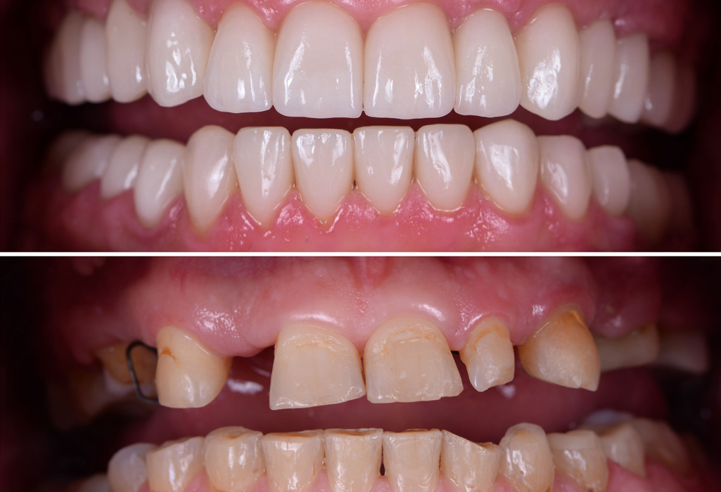 Patient with plastic dentures
