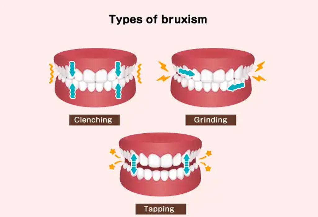 Protective mouthguard example