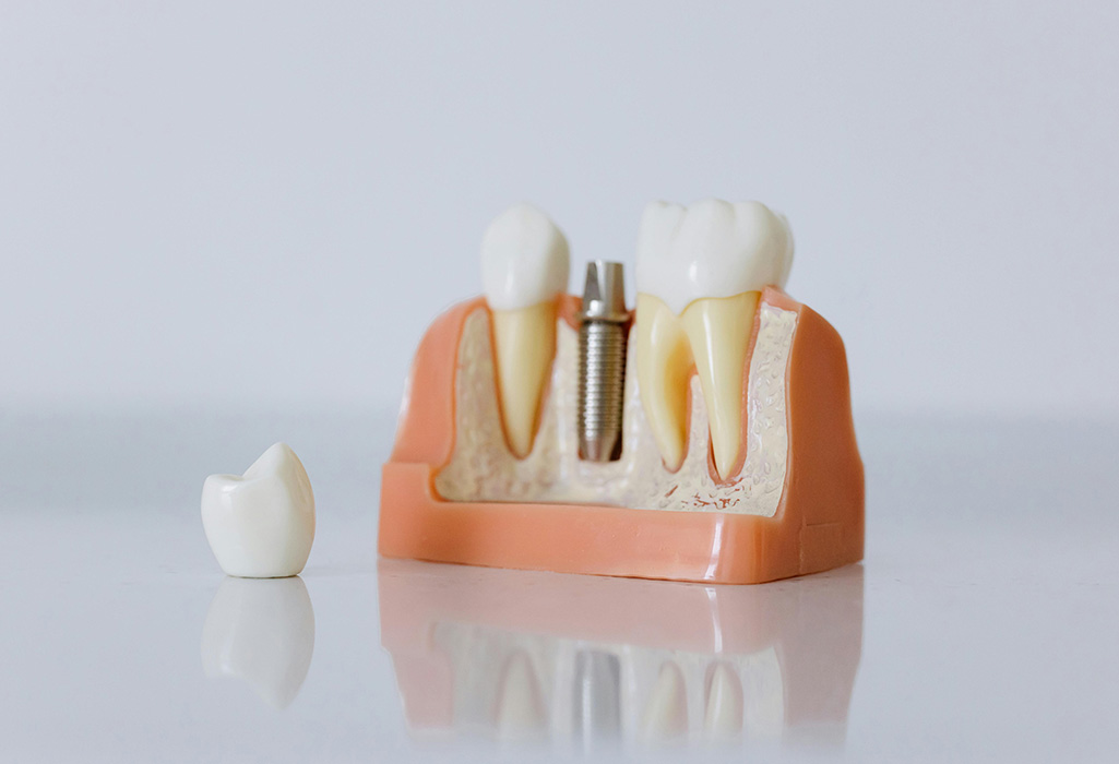 Restorative dentistry procedure