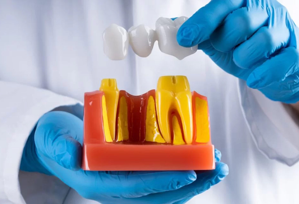 Completed dental restoration result