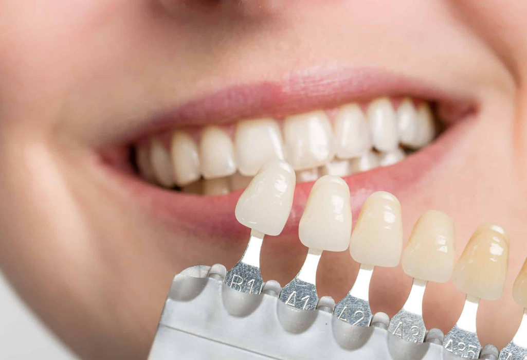 Teeth whitening - before
