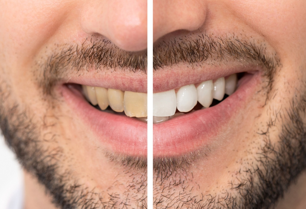 Teeth whitening treatment in progress