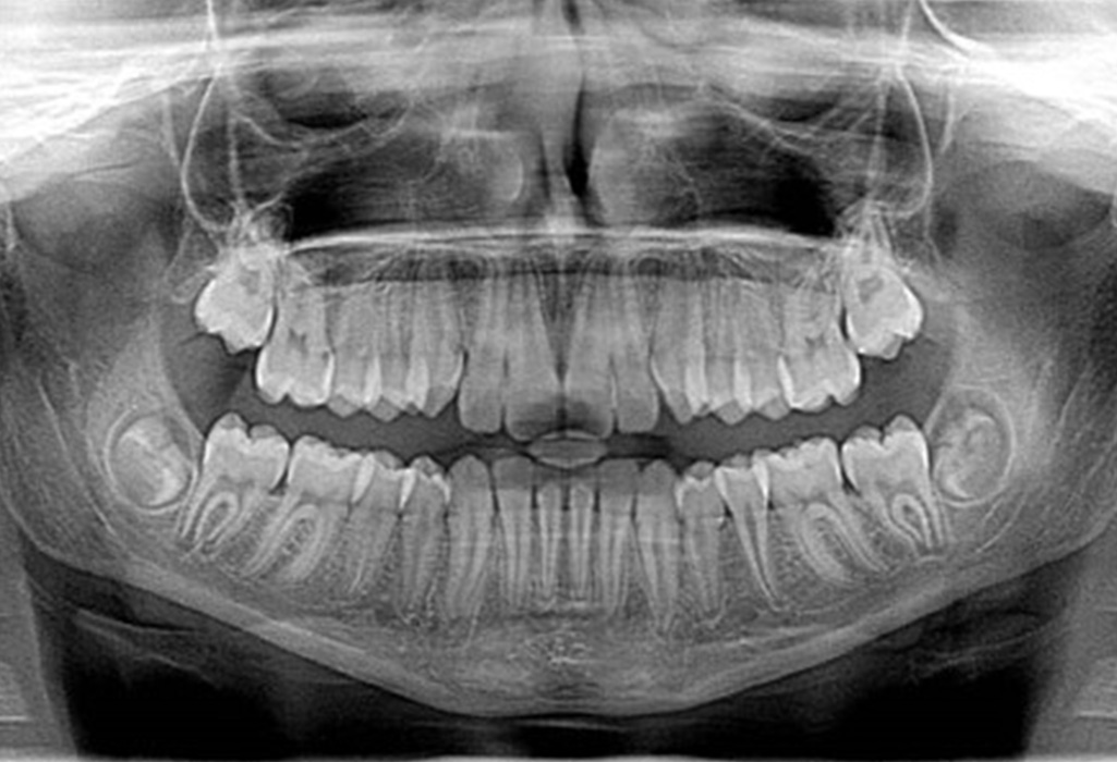 Dental x-ray image