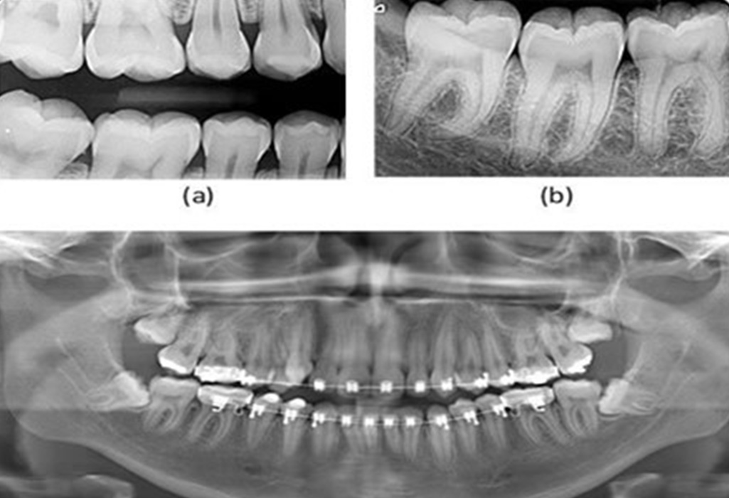Panoramic dental x-ray